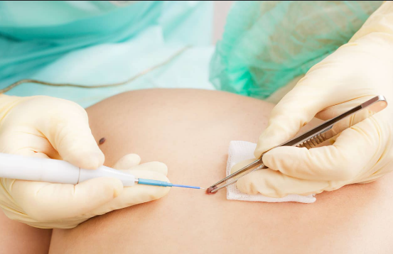 Chirurgie dermatologique